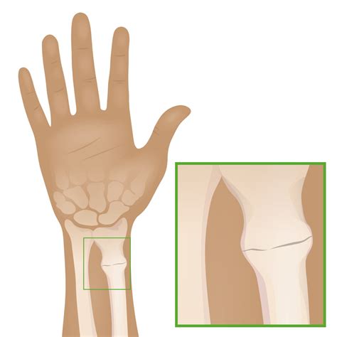 Buckle or Torus Fracture | Concise Medical Knowledge