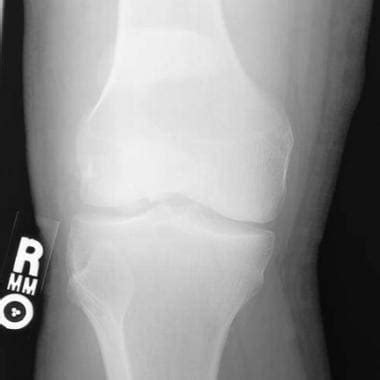 Patella Fracture Imaging: Practice Essentials, Radiography, Computed Tomography