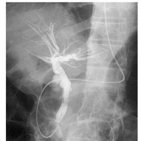 Preoperative endoscopic retrograde cholangiopancreatography image ...