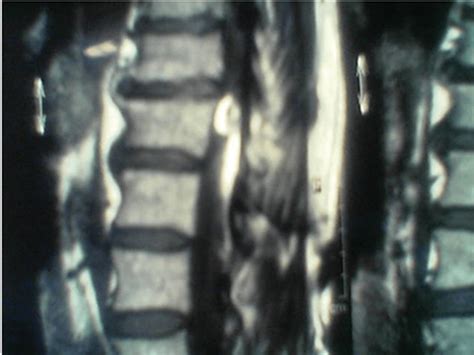 Complications of Intrathecal Drug Delivery Systems and Drugs Used | Anesthesia Key