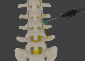 Medial Branch Block - Cervical, Thoracic and/or Lumbar | West Michigan Surgery Center