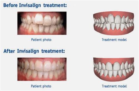 The Step-by-Step Process of Invisalign Braces!