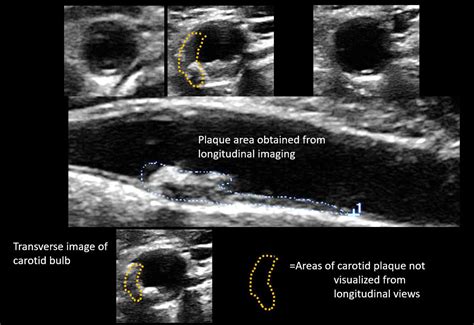 Sonographic assessment of carotid atherosclerosis: preferred risk indicator for future ...