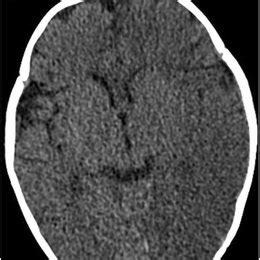 The Big Black Brain: Subdural Hemorrhage with Hemispheric Swelling and ...