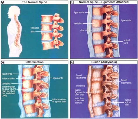 Bamboo spine, ankylosing spondylitis | auto-immune disease | Ankylosing ...