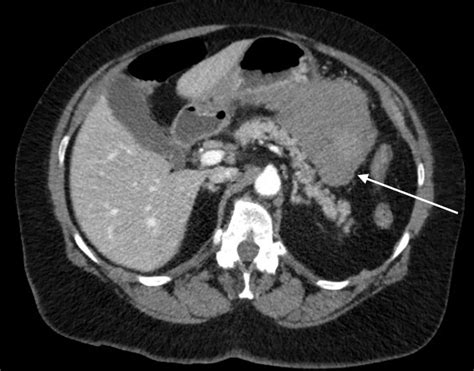 Cureus | Spontaneous Hemoperitoneum From a Ruptured Gastrointestinal Stromal Tumor