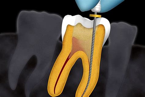 What is Endodontic Success? - Directorio Odontológico