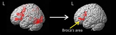 Forming ROI in Broca's area. Activation from the action-naming task is... | Download Scientific ...