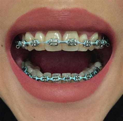 #braces #girlswithbraces #powerchain #headgeartubes | Braces colors ...