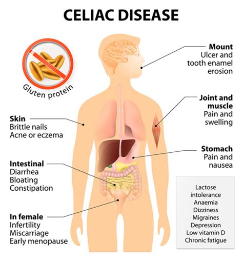 Celiac Disease Symptoms Checklist | Celiac Disease Symptoms