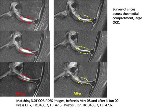 Micro fracture versus stem cells