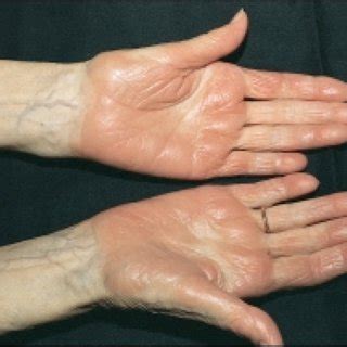 Palmar edema and erythema, with fine desquamation (palmar plantar ...