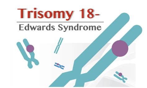 Trisomy 18- Definition, Symptoms, Pictures, Diagnosis And Life Expectancy