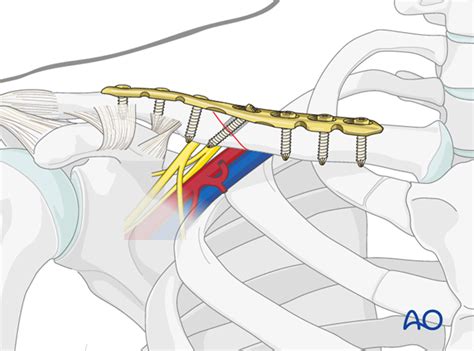 Floating shoulder - Sequence of repair