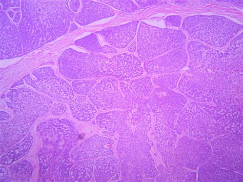 Adenoid cystic carcinoma – Histopathology.guru