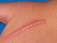 Hypertrophic Scar – Causes, Treatment, Removal and Healing