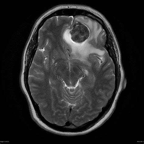 Solitary fibrous tumor of brain | Image | Radiopaedia.org