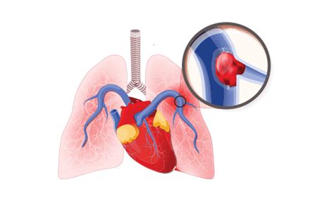 FlowTriever System Is a First-of-Its-Kind Treatment for Blood Clots