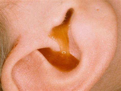 Ear Infection In Babies: 10 Ear Infection Symptoms In Babies