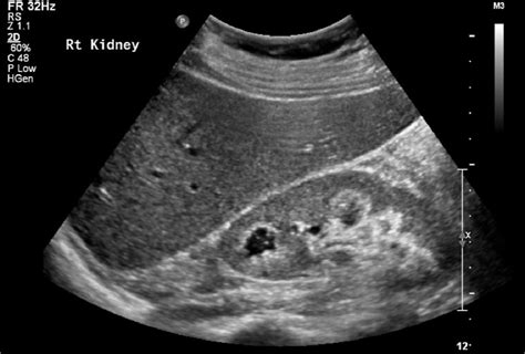 Medullary Sponge Kidney and Medullary Nephrocalcinosis - Stephen Johnson, 2013