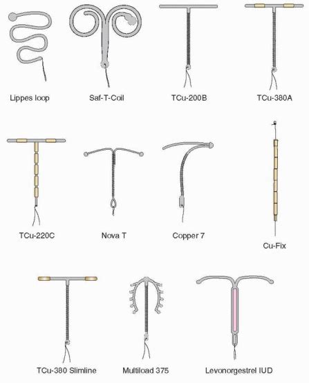 Iud Types : There are 5 types of IUDs -- here's how to choose the best ... / In this article ...