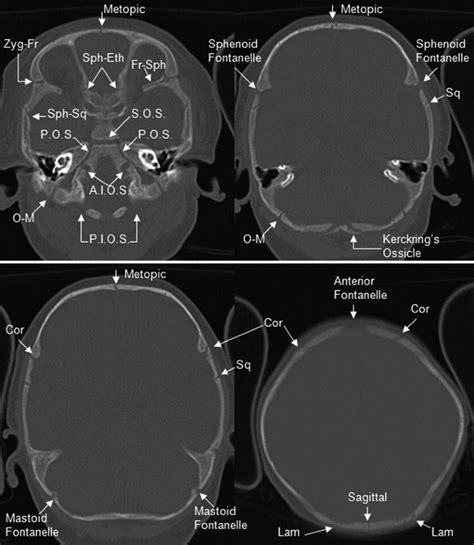 Pediatric Skull: Normal Pediatric Sutures on Computed Tomography | SpringerLink