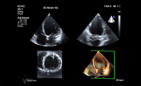 3d Ultrasound Of The Heart