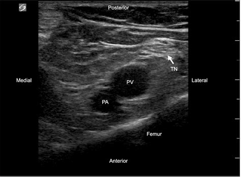 Popliteal Veins Ultrasound Anatomy