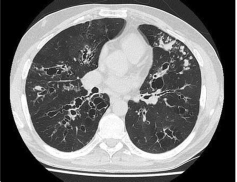 Bronchiectasis: a case-based approach to investigation and management | European Respiratory Society