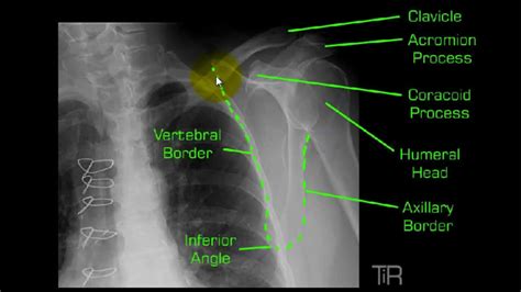 Y-view shoulder.mp4 - YouTube