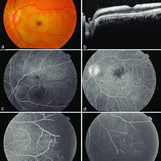 (a) Fundus photograph of the left eye shows a cherry-red spot at the... | Download Scientific ...