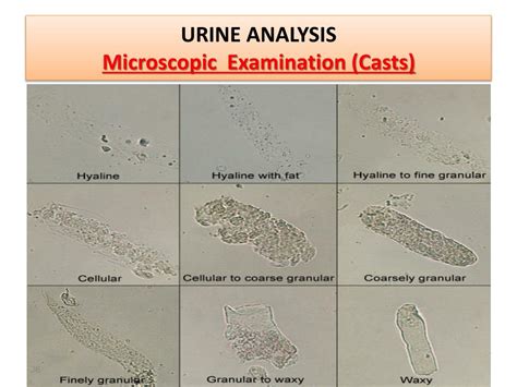 Yeast Urine Microscopic