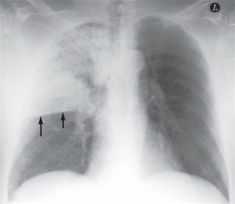 Bronchopneumonia Chest X Ray