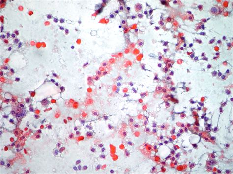 Cytopathology of lymph nodes-FNAC – Cellnetpathology.com