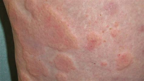 STRESS RASH - How To Identify and Treat Rashes Caused By Stress