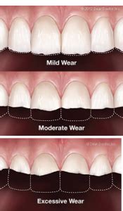 Effects of Clenching or Grinding your Teeth - Church Street Dental & Implant Clinic