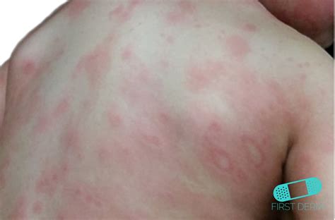 Online Dermatology - Erythema multiforme