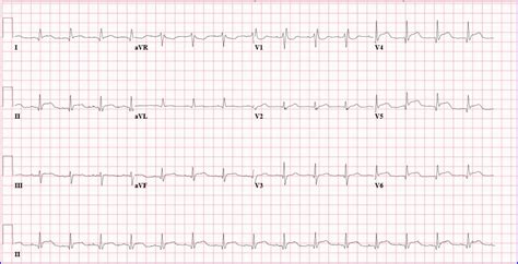 What is the diagnosis of this ST elevation MI mimic? | little white coats