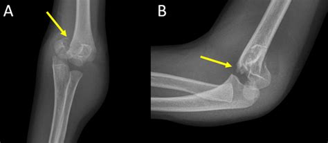 Supracondylar Fracture Fat Pad Sign