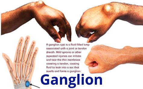 Ganglion Cyst Wrist Images