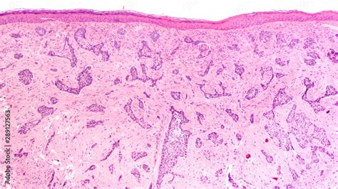 Photomicrograph of skin biopsy showing a sclerosing (morpheaform) basal cell carcinoma. 스톡 사진 ...