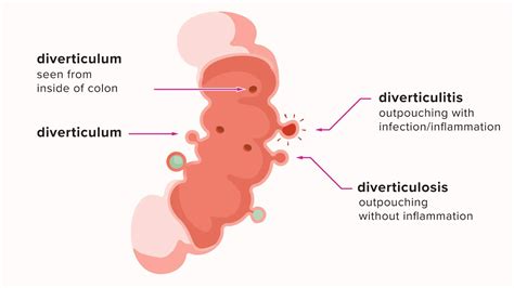 Diverticulitis and Diverticulosis