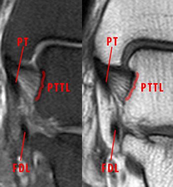 Deltoid Ligament Injuries | Radsource