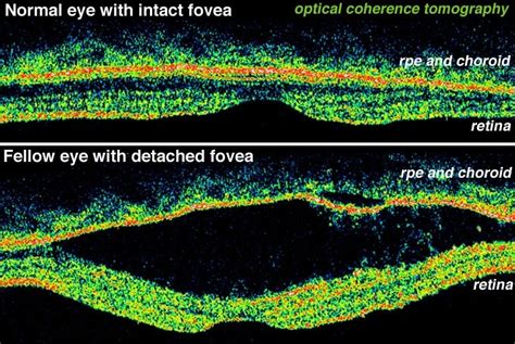 Figure 31b, [Optical coherence tomography (OCT) images...]. - Webvision - NCBI Bookshelf