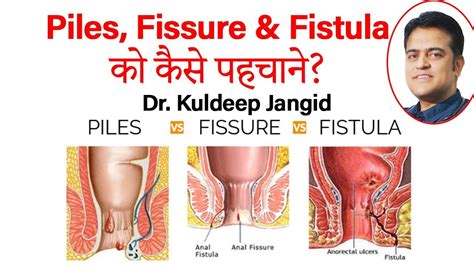 Difference in Piles, Fissure and Fistula |पाइल्स फ़िस्सुर औऱ फिस्टुला में अंतर | Symptom of ...