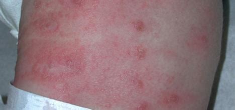 Mild Scabies Rash