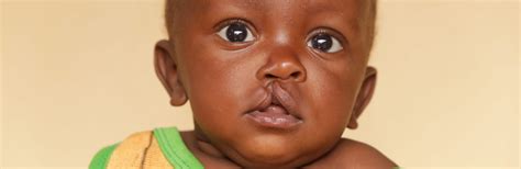 Why we should no longer call cleft lip a “harelip” – Deutsche Cleft Kinderhilfe e.V.