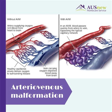 Pulmonary atresia symptoms and causes – Artofit