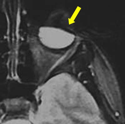 Susceptibility artifact - Questions and Answers in MRI