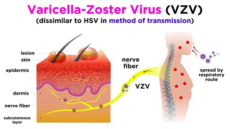 Varizella-zoster-virus - Captions Hunter